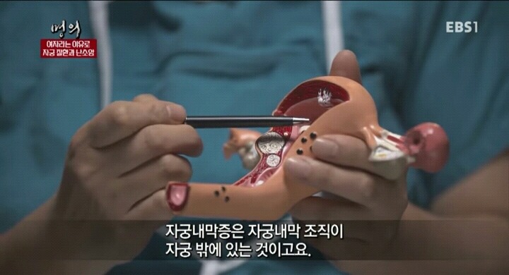 자궁내막조직이 자궁밖에 존재하는 자궁내막증.jpg | 인스티즈
