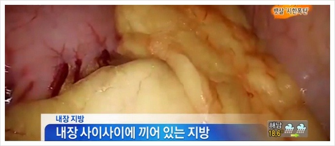 침묵의 암살자 뱃속의 시한폭탄 내장지방의 위험성 | 인스티즈