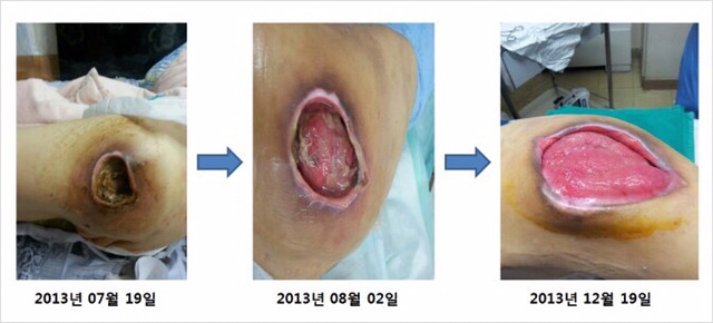 일상생활장해가 있는 환자들이 가장 무서워하는 질병...(많이 충격적일수있으니까 주의하세요) | 인스티즈