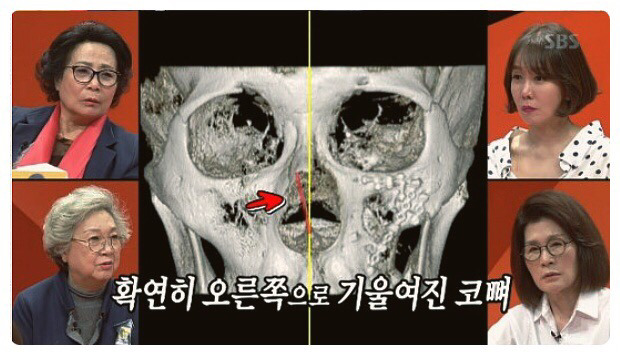 이상민 얼굴에 박혀있는 수많은 나사 | 인스티즈