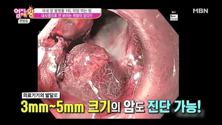 내시경으로 안 보이는 위암이 있다? | 인스티즈