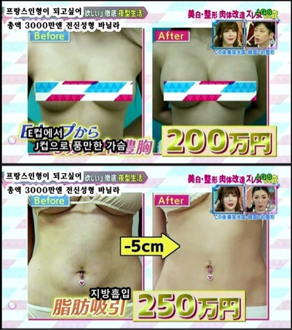 프랑스 인형이 되고싶어 총액 3000만엔 전신성형한 바닐라 | 인스티즈