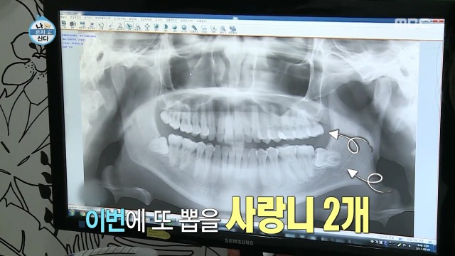 [나혼자산다] 너도나도 공감하는 공포의 사랑니 빼기 | 인스티즈